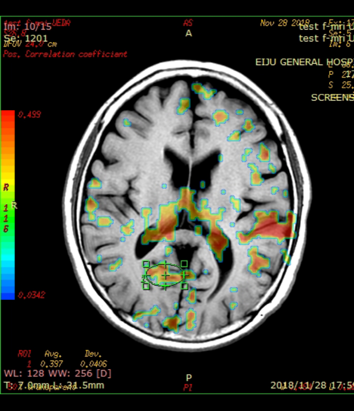 バレエを踊っている時の脳活動を機能的MRIでとらえた画像
